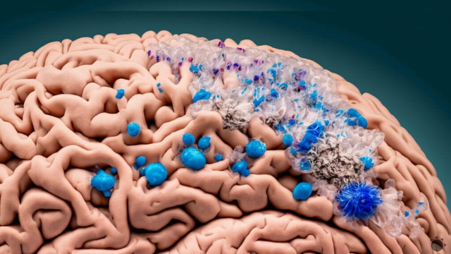 Mikroplasty a mozog: Nová štúdia odhaľuje znepokojujúce účinky